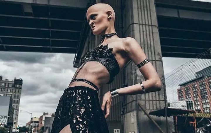 28岁患有罕见基因异常疾病的女模打破了众人对时尚的印象