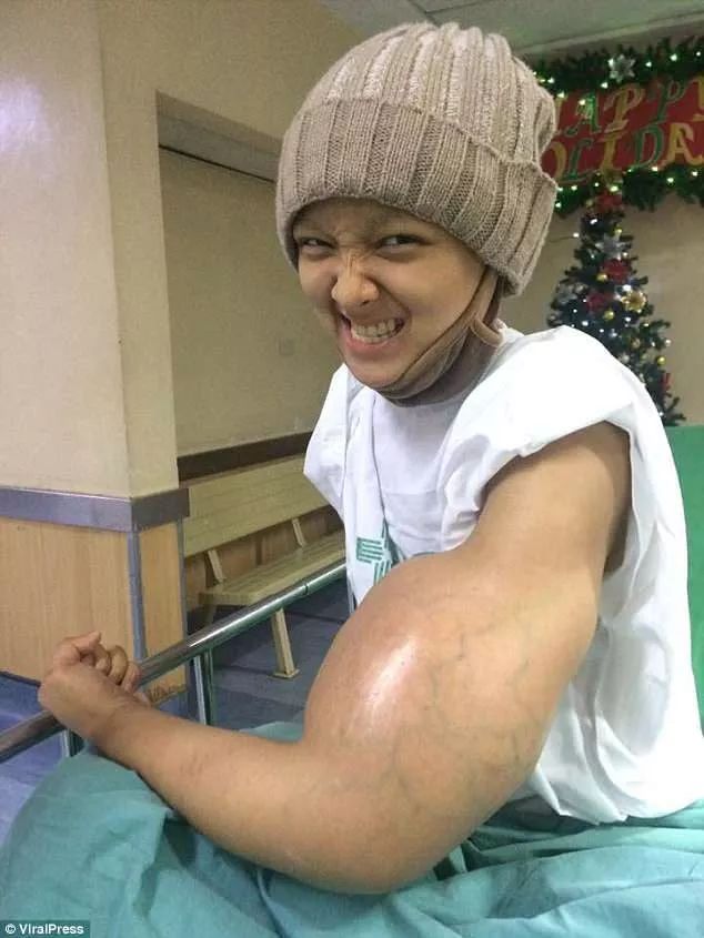 以为被蚊子叮!少女手臂肿成“大力水手”17次化疗失败忍痛截掉:暂时不用担心了