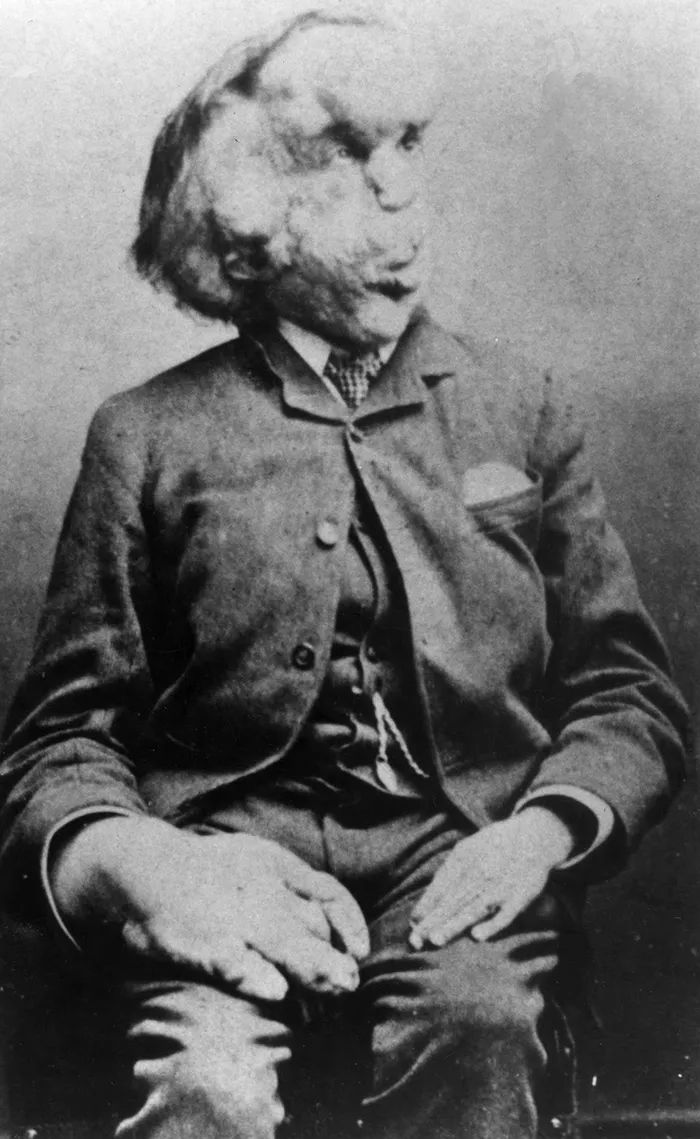 找到了！英国“象人”葬身处130年来首度曝光，他靠畸形赚钱维生