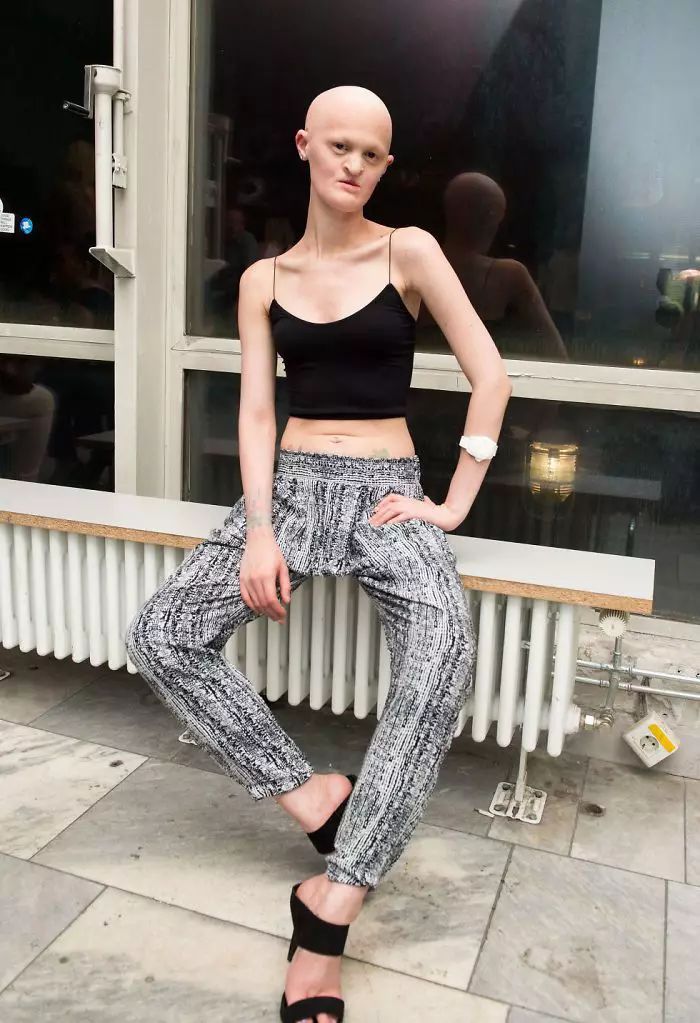 28岁患有罕见基因异常疾病的女模打破了众人对时尚的印象
