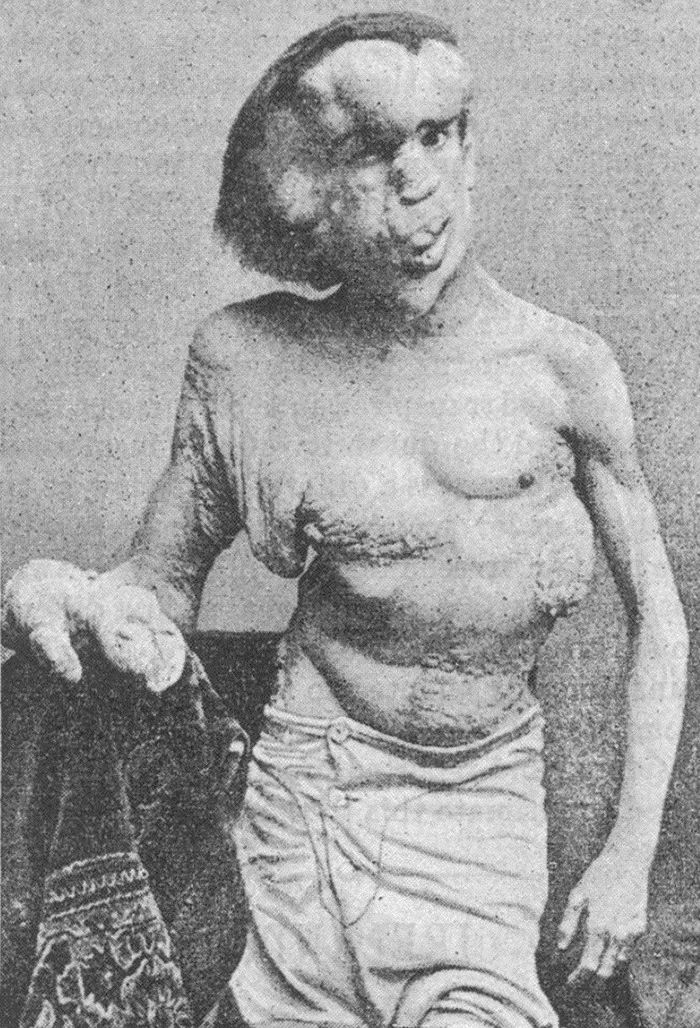 找到了！英国“象人”葬身处130年来首度曝光，他靠畸形赚钱维生