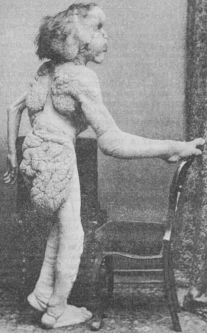 找到了！英国“象人”葬身处130年来首度曝光，他靠畸形赚钱维生