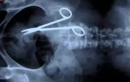 异物入体X光照，有点奇葩！