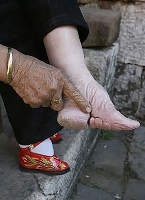 古代传统极端缠足文化照片，X光看起来太可怕！