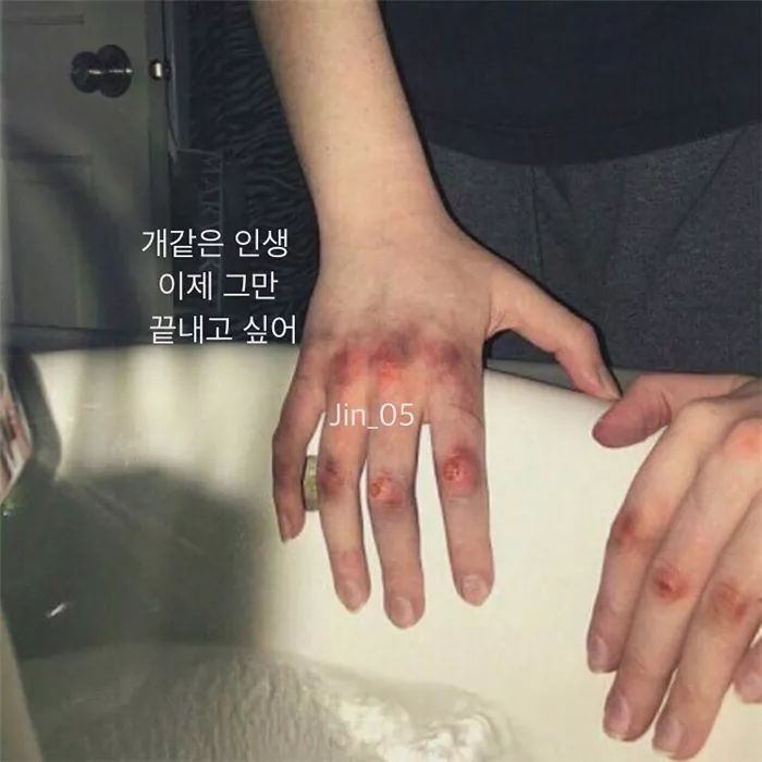 韩国少年10岁开始流行拍自残照，割腕烫烟蒂！