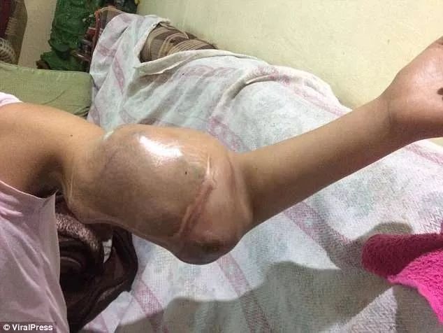 以为被蚊子叮!少女手臂肿成“大力水手”17次化疗失败忍痛截掉:暂时不用担心了