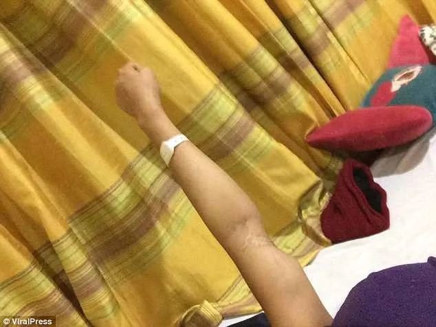 以为被蚊子叮!少女手臂肿成“大力水手”17次化疗失败忍痛截掉:暂时不用担心了