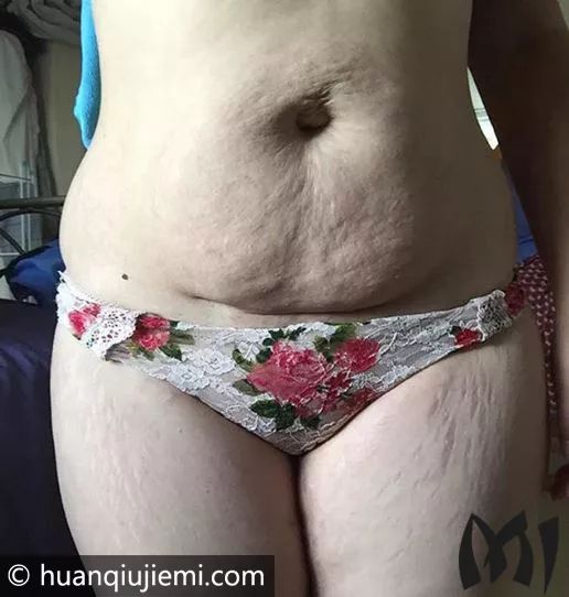 15个生产后身体惊人变化的妊娠纹照片，母亲真的很伟大！
