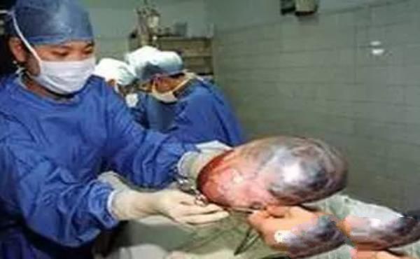 重庆一男子“怀孕”30年产下一怪胎